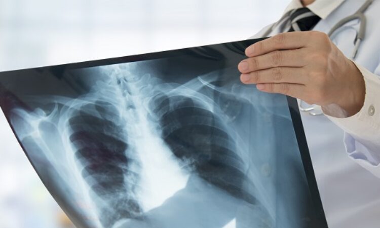 What is Pneumoconiosis, and can I make a claim for it?